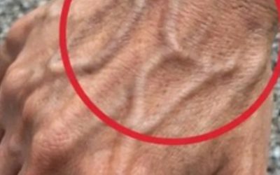Als je zichtbare aderen hebt, betekent dit dat je…