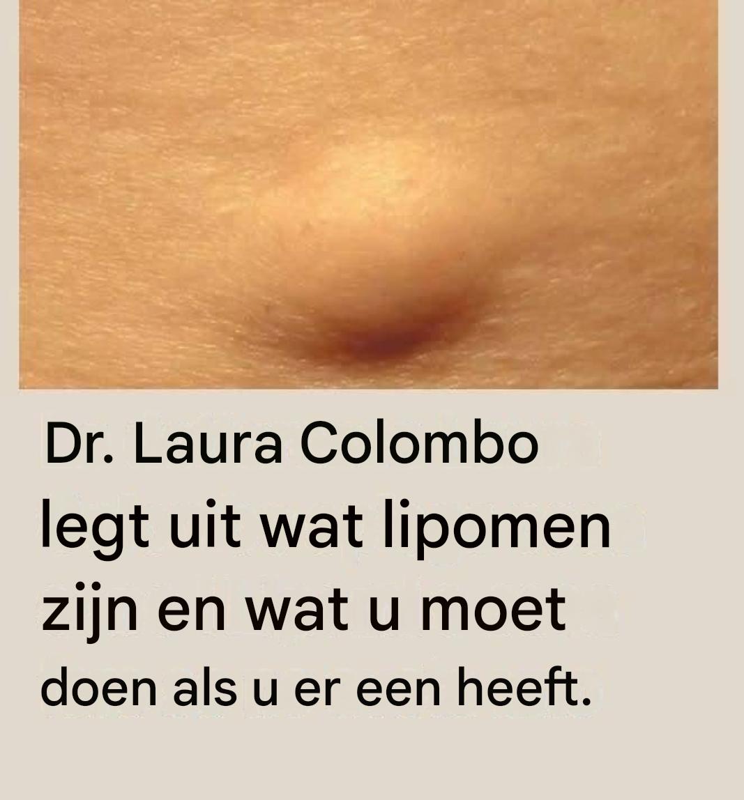 Dr. Laura Colombo legt uit wat lipomen zijn en wat u moet doen als u er een heeft (1 / 2)