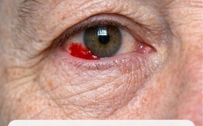 Mijn 64-jarige echtgenoot werd wakker met een rode, bloedende plek op zijn oog. Moeten we naar het ziekenhuis?