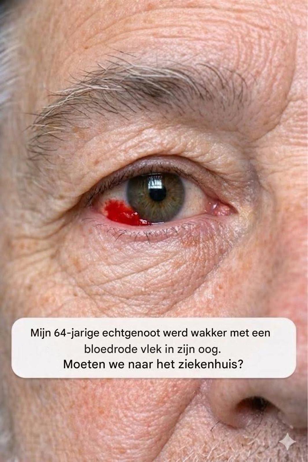 Mijn 64-jarige echtgenoot werd wakker met een rode, bloedende plek op zijn oog. Moeten we naar het ziekenhuis?
