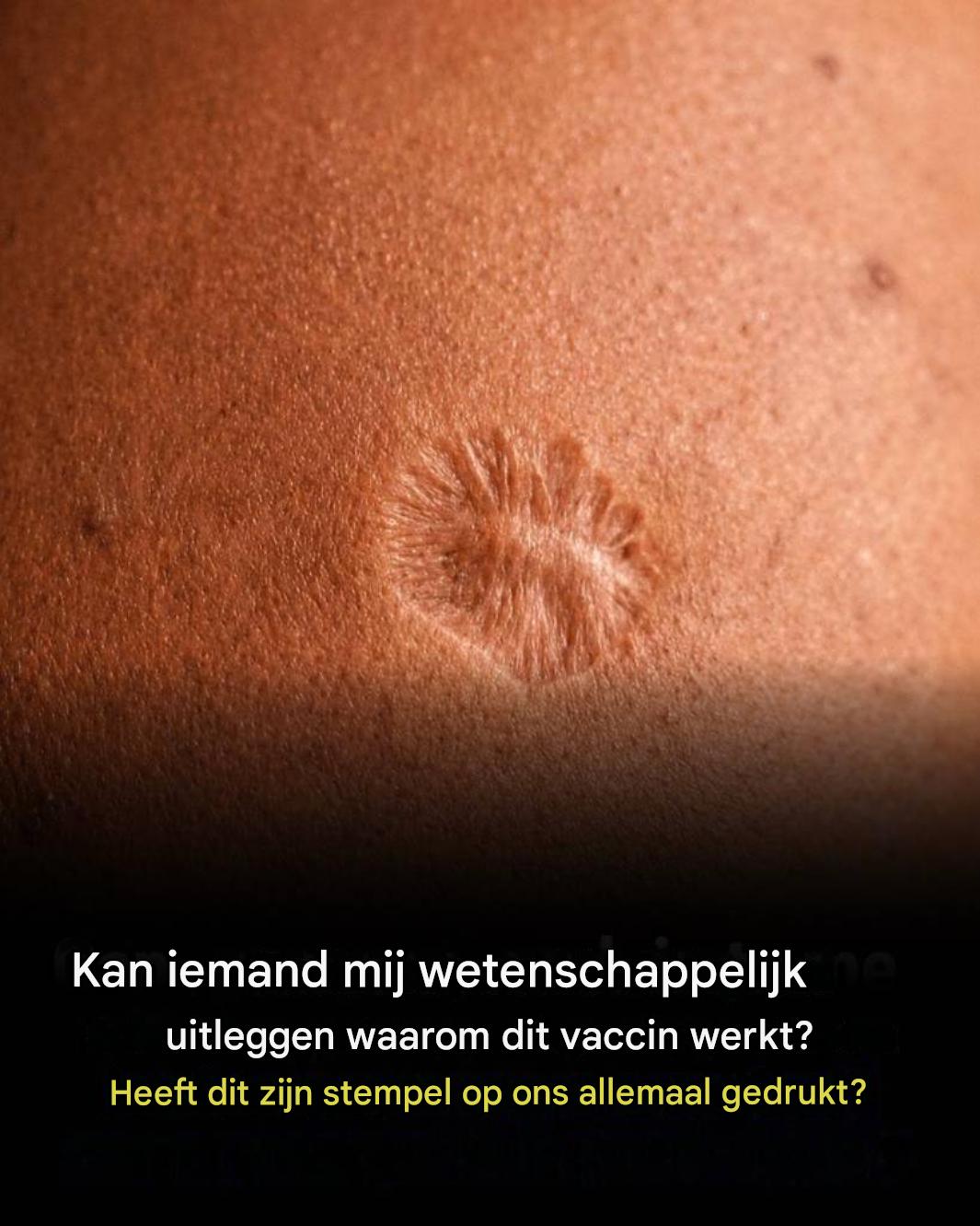 Pokken: Waarom is het bekende vaccinatie-litteken zo zichtbaar?