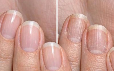 Breng deze oplossing aan op je nagels en voorkom schilfering, barstjes en ruwe strepen.