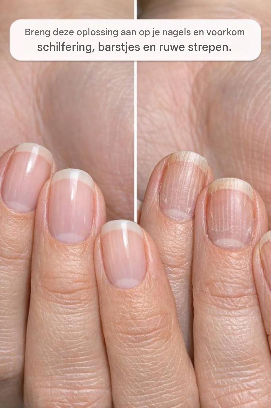 Breng deze oplossing aan op je nagels en voorkom schilfering, barstjes en ruwe strepen.
