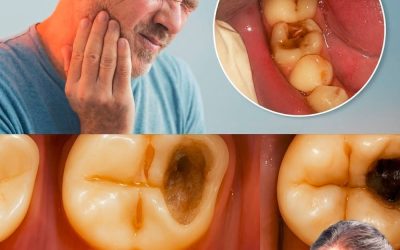 🦷Houd deze tips in gedachten om een ​​bezoek aan de tandarts te vermijden. 🦷Hoe je op natuurlijke wijze een gaatje kunt repareren – Het volledige recept vind je in de eerste reactie.