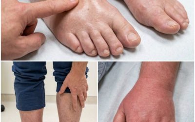 Ringen die strakker gaan zitten, schoenen die ineens te strak zitten: deze onverwachte zwellingen zeggen veel over je gezondheid.