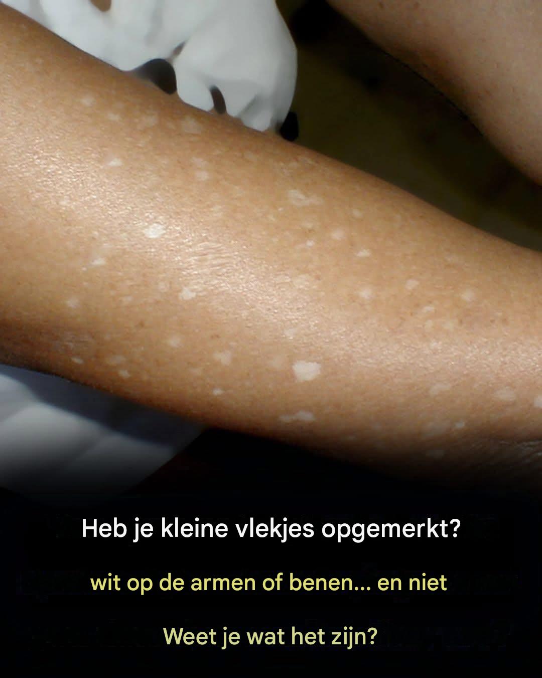 Heb je kleine witte vlekjes op je armen of benen opgemerkt? Dit zijn ze.