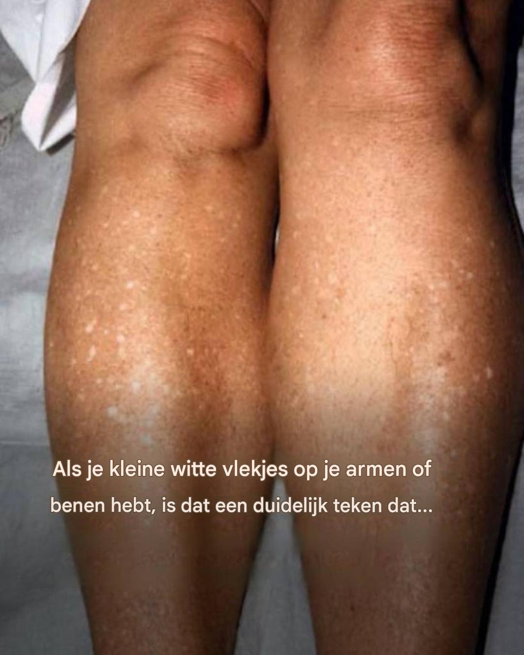 Waarom krijg ik in de zomer witte vlekjes op mijn huid en hoe kan ik die behandelen? Een dermatoloog geeft antwoord.