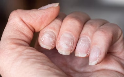 Nagelschimmel: hoe je het kunt bestrijden met waterstofperoxide en andere effectieve middelen