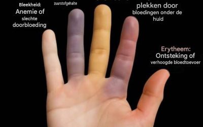 Je huid kan je waarschuwen voor een verborgen gezondheidsprobleem – negeer deze signalen niet.